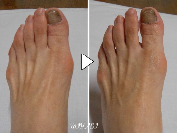 美脚整体コースで外反拇指の改善（60代　女性　施術1回）